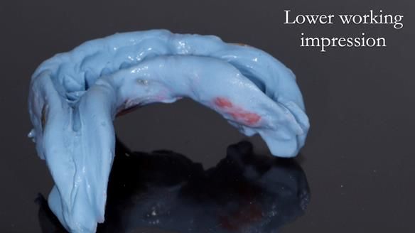 Eileen's transformation with upper and lower RPDs of Scandinavian hygienic design FULL PROTOCOL