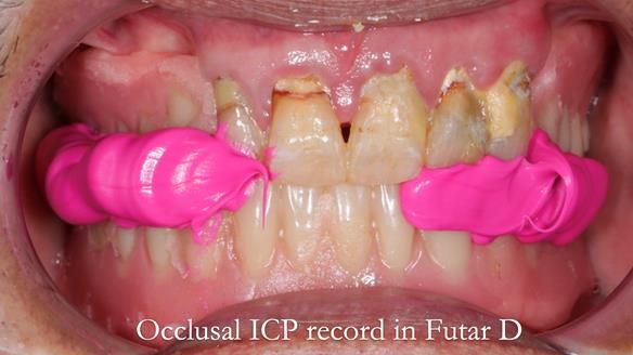 Finlay's Newsletter 62 provision of extractions and metal based complete dentures for Rafique