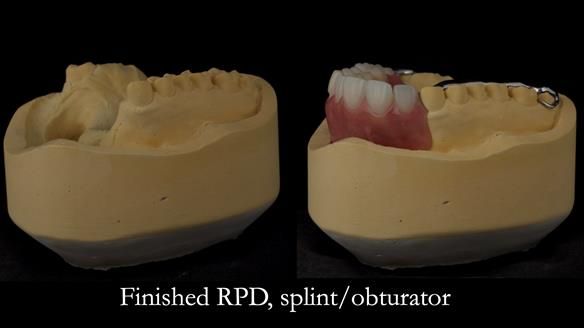 Upper metal base partial denture/occlusal stabilisation splint/obturator - full protocol