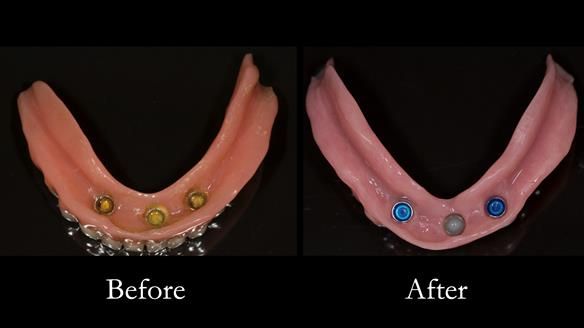 After - optimally border moulded to the functionally depth and width of the suli - giving optimal support to the dentures, not being overly reliant on the implants.