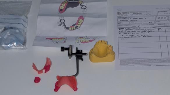 Newsletter 86 Peter the Architect — precision removable partial dentures case study