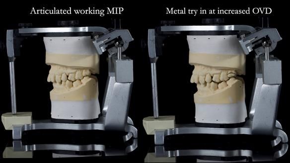 Finlay's Newsletter 64 case study - provision of a Kennedy class 2 metal based Scandinavian RPD for Ian