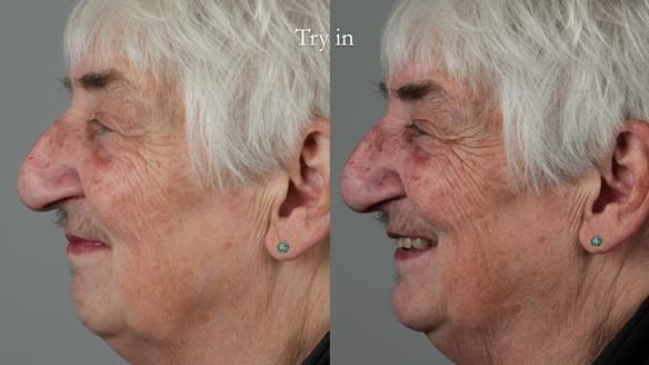 Newsletter 55 Provision of metal based partial dentures for Zephyrine with a repaired cleft lip and palate