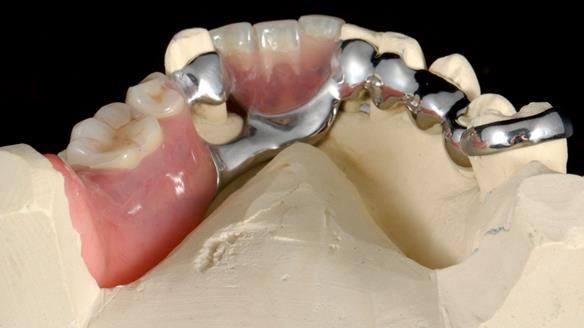 Newsletter 86 Peter the Architect — precision removable partial dentures case study