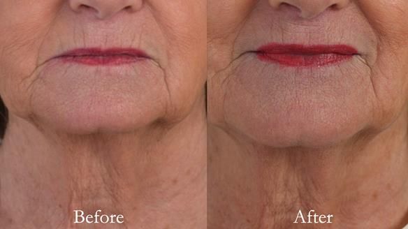 Lip support improved