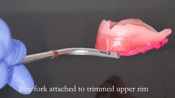 Newsletter 54 case presentation upper complete denture and lower Scandinavian designed hygienic partial denture for David