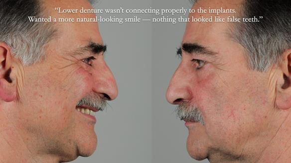 Newsletter 78: What do Clark Gable and a Locator® overdenture have in common?