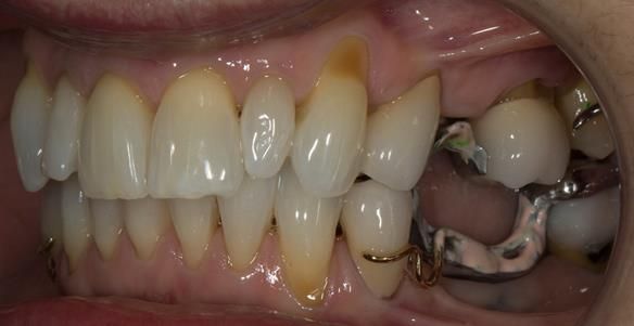Figure 75 Cobalt chromium framework trial insertion, checking the occlusion - ensuring no propping of the bite. ICP tooth to tooth contact maintained - occlusion identical with and without the framework in-situ