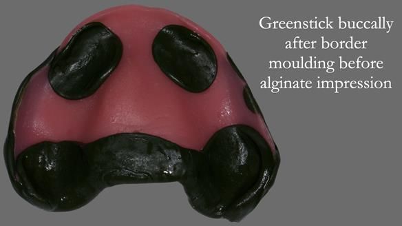 Newsletter 52 Managing Jo’s failing dentition with extractions and Mk 1/Mk 2 complete upper dentures and lower partial dentures FULL PROTOCOL