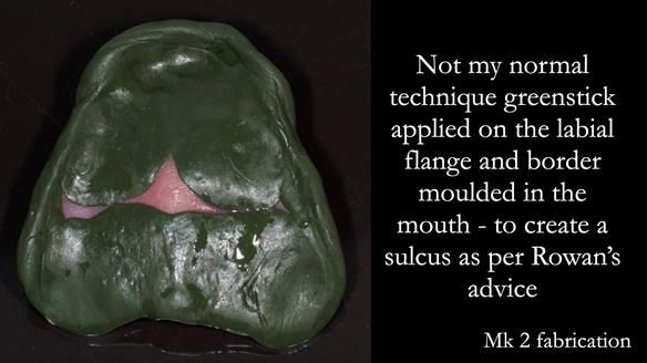 Replacing Madeline’s Complete denture FULL PROTOCOL