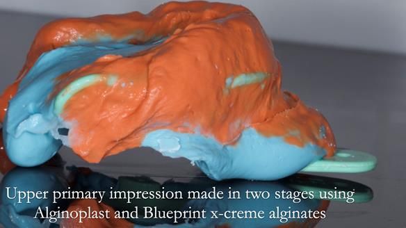 Solving Linda’s Failed “All on 4” implant bridges - full protocol Newsletter 42