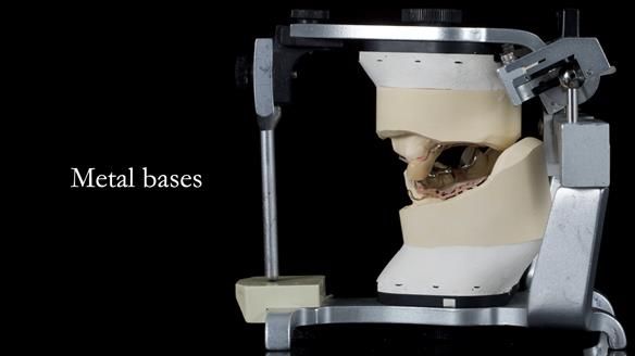 Newsletter 55 Provision of metal based partial dentures for Zephyrine with a repaired cleft lip and palate