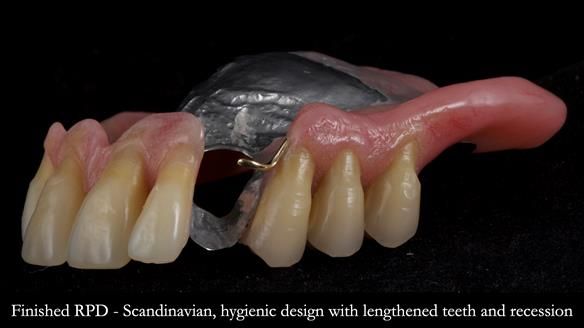 Finlay's Newsletter 59 Ultra hard partial dentures made for Gill