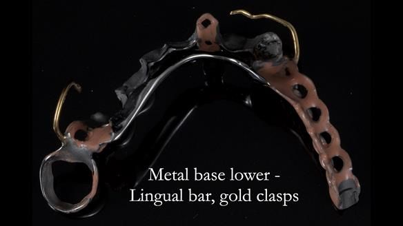 Newsletter 55 Provision of metal based partial dentures for Zephyrine with a repaired cleft lip and palate