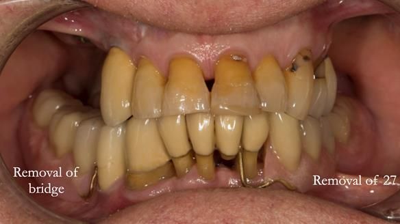 Ken – going downhill, first class