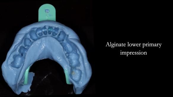 Newsletter 77: Jeremy’s case – immediate complete upper denture