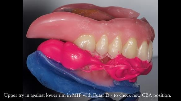 Newsletter 80 - Gordon’s dentures: the one case in 1,000 where my technique failed