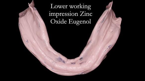 Complete denture Class II div 2 deep overbite Newsletter 39