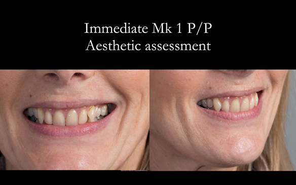  Figure 51 Assessment of the aesthetics - immediate denture are great diagnostic dentures - improvements can be made in the definitive dentures