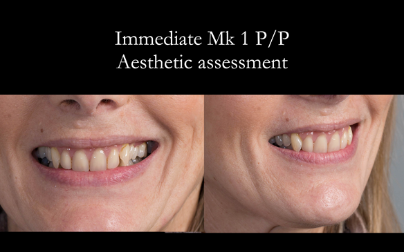Figure 51 Assessment of the aesthetics - immediate denture are great diagnostic dentures - improvements can be made in the definitive dentures