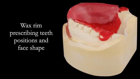 Upper metal base partial denture/occlusal stabilisation splint/obturator - full protocol