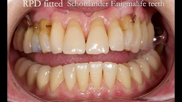 Finlay's Newsletter 59 Ultra hard partial dentures made for Gill