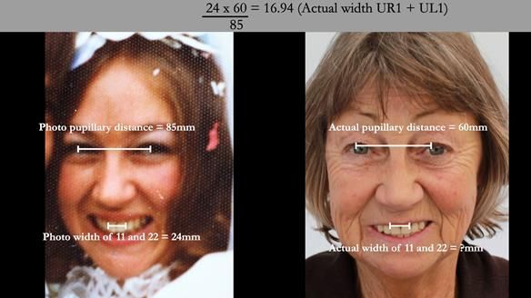 If a frontal dentate photograph of the patient is available then Dr John Besfords tooth size calculation formula can be used to calculate the size of the prosthetic teeth.