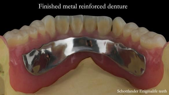 Finished metal reinforced implant supported over denture