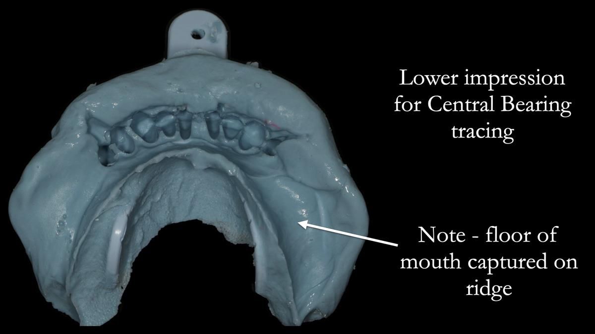 Newsletter 87 – Father Peter: A Partial Denture that needed Minor Miracle