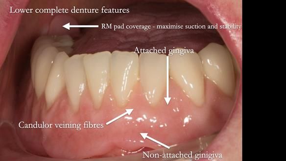 Newsletter 75: Marion’s case - Step-by-step complete denture workflow