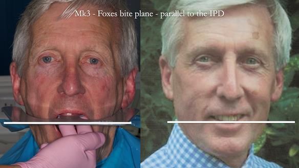 Newsletter 77: Jeremy’s case – immediate complete upper denture