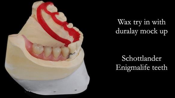 Finlay's Newsletter 61 provision of a lower unilateral free end saddle metal based partial denture for Joyce