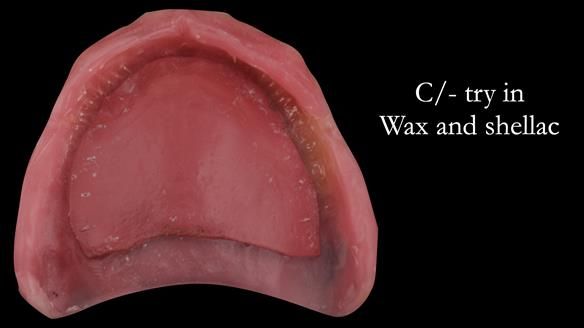 Managing poor implant positioning with complete dentures and Locator attachments - full protocol Newsletter 41