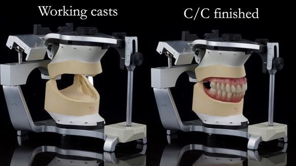 Replacing Madeline’s Complete denture FULL PROTOCOL