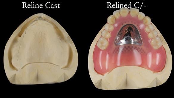 Newsletter 54 case presentation upper complete denture and lower Scandinavian designed hygienic partial denture for David