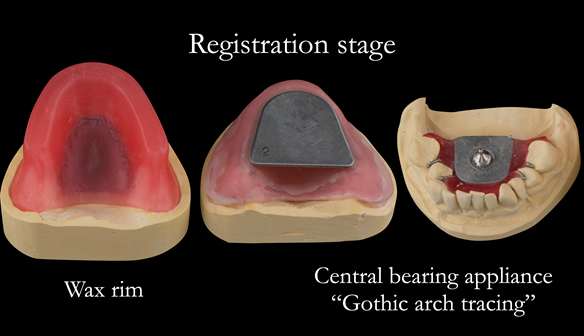 Figure 63 Registration visit with wax rim for tooth position/OVD recording and central bearing apparatus for CR recording