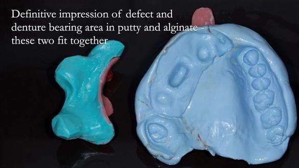 Upper metal base partial denture/occlusal stabilisation splint/obturator - full protocol