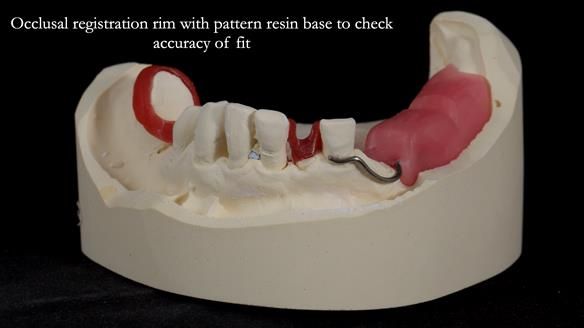 Newsletter 55 Provision of metal based partial dentures for Zephyrine with a repaired cleft lip and palate
