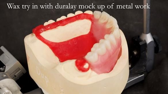 Upper metal base partial denture/occlusal stabilisation splint/obturator - full protocol
