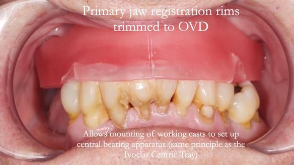 Newsletter 54 case presentation upper complete denture and lower Scandinavian designed hygienic partial denture for David