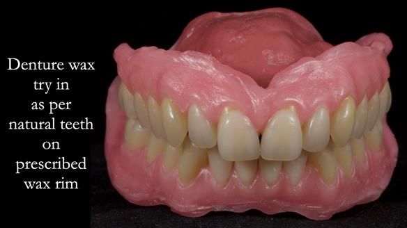 Newsletter 57 showcases the making and fitting process of implant-supported complete dentures for Alisdair