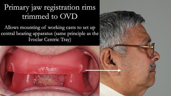Finlay's Newsletter 62 provision of extractions and metal based complete dentures for Rafique