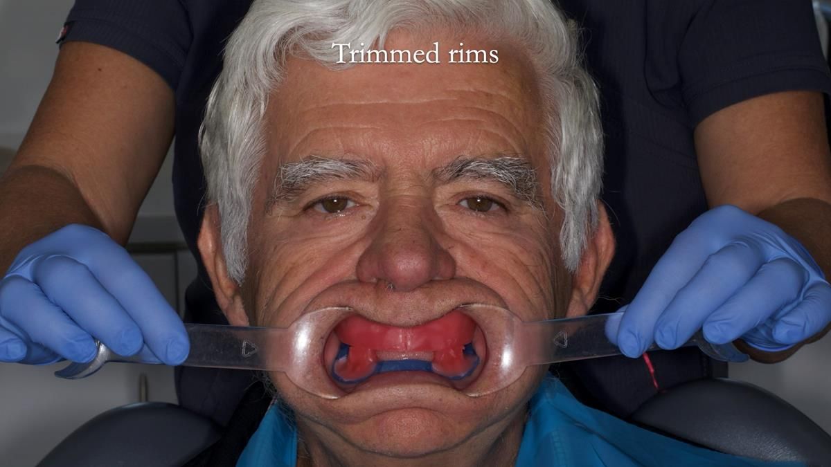 Fin’s Newsletter 88 — Complete dentures - full protocol… he rearranged his own teeth!