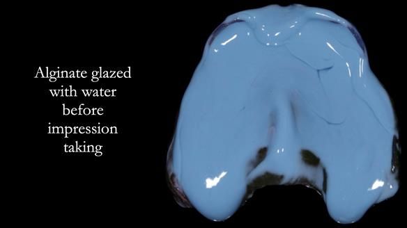 Newsletter 77: Jeremy’s case – immediate complete upper denture