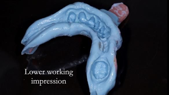 Eileen's transformation with upper and lower RPDs of Scandinavian hygienic design FULL PROTOCOL