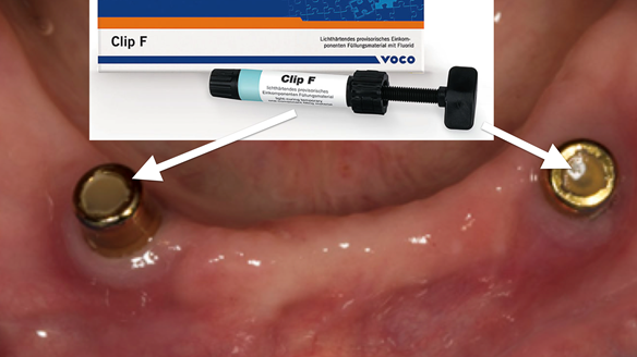 Figure 10 A superb tip Prof Frauke Muller taught me. A temporary filling material placed into the top of the abutment prevents food from collecting