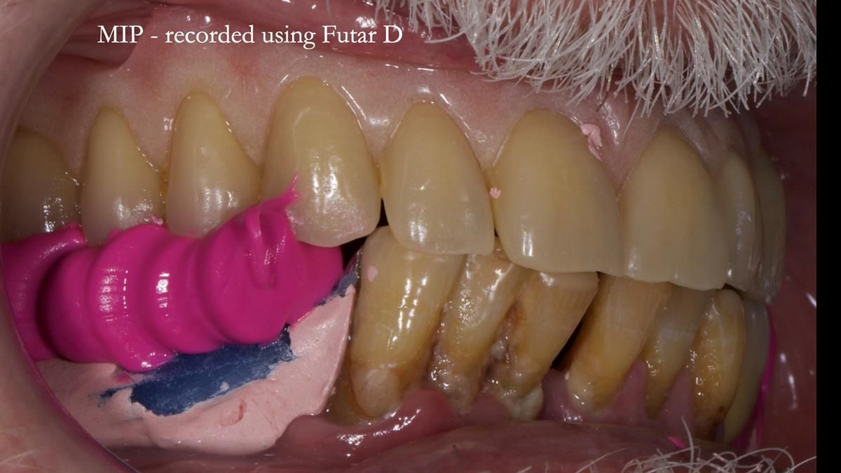 Newsletter 87 – Father Peter: A Partial Denture that needed Minor Miracle