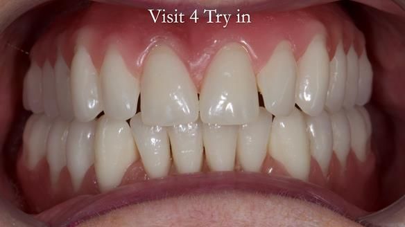 Replacing Madeline’s Complete denture FULL PROTOCOL