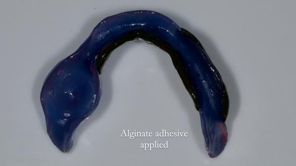 Newsletter 82 Mary - A complete upper and a one-tooth gasket denture