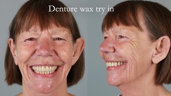 Newsletter 76: Jackie’s case – Telescopic overdenture & precision RPD (the tricky truth!)